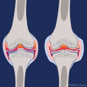 Knee Joint Pathology 1